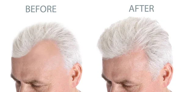 Pandangan Tertutup Terhadap Pria Senior Sebelum Dan Sesudah Perawatan Rambut — Stok Foto