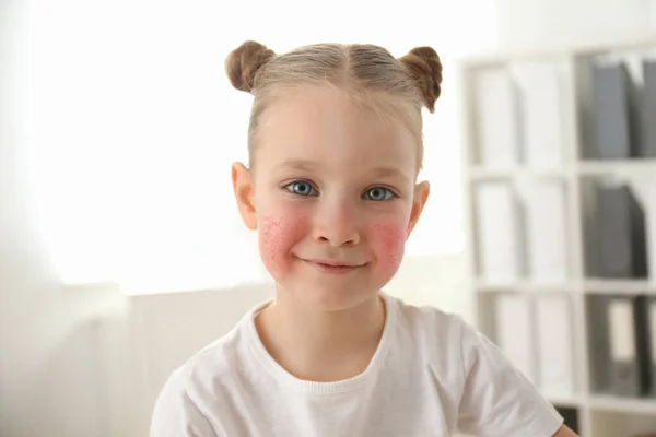 Schattig Klein Meisje Met Allergie Symptomen Wangen Thuis — Stockfoto