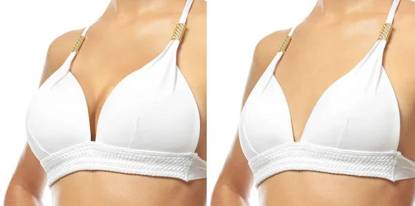 白の背景に乳房サイズ補正前後の若い女性の写真とコラージュ クローズアップ バナーデザイン — ストック写真