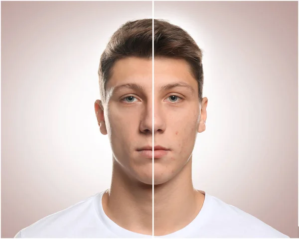 Adolescente Cara Com Problema Acne Antes Depois Tratamento Fundo Claro — Fotografia de Stock