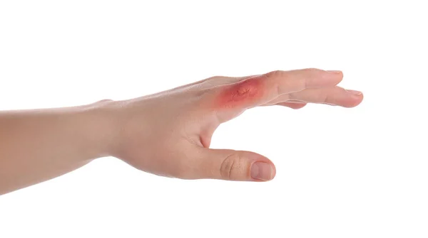 Woman Burn Her Hand White Background Closeup — Stock Photo, Image