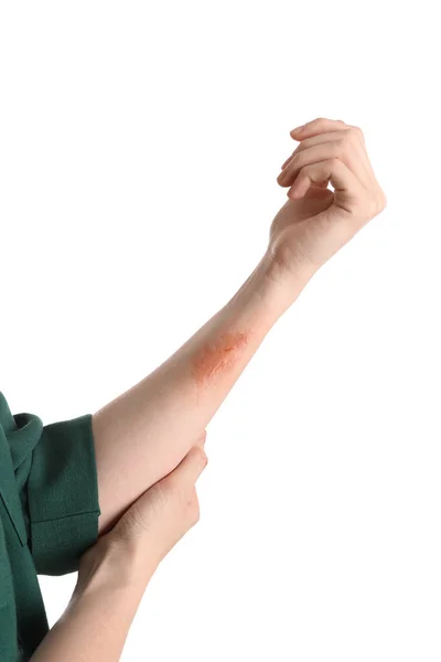 Woman Burned Hand White Background Closeup — Stock Photo, Image