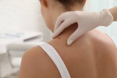 Dermatolog klinikte hastanın doğum lekesini inceliyor.