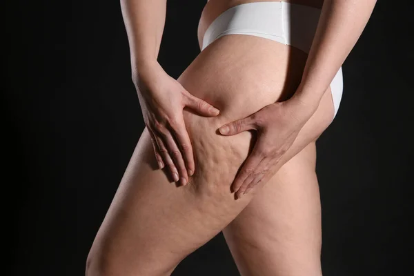 Frau Mit Cellulite Auf Schwarzem Hintergrund Nahaufnahme — Stockfoto