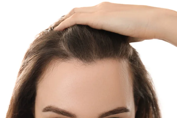 Woman Suffering Baldness White Background Closeup — Stock Photo, Image