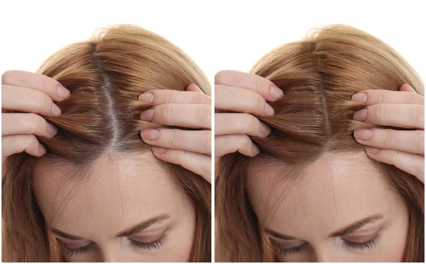 Woman Suffering Baldness White Background Closeup Collage Photos Treatment — Stock Photo, Image