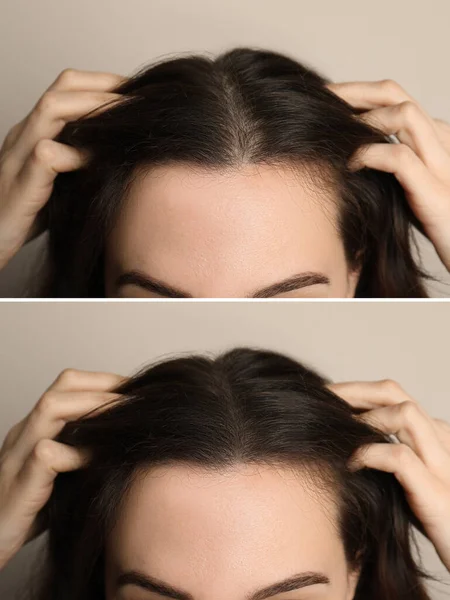 Woman Suffering Baldness Beige Background Closeup Collage Photos Treatment — Stock Photo, Image