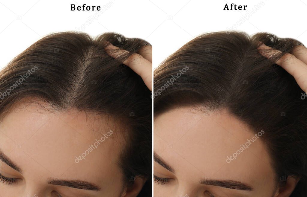 Woman suffering from baldness on white background, closeup. Collage with photos before and after treatment