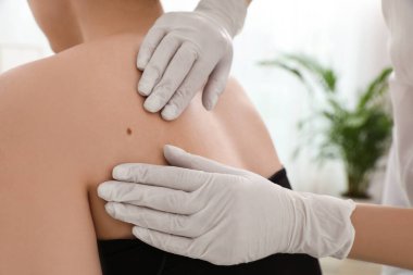 Dermatolog klinikte hastanın doğum lekesini inceliyor.