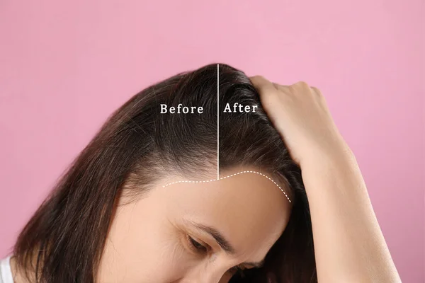 在粉色背景下秃顶的女人 治疗前后的拼贴 — 图库照片