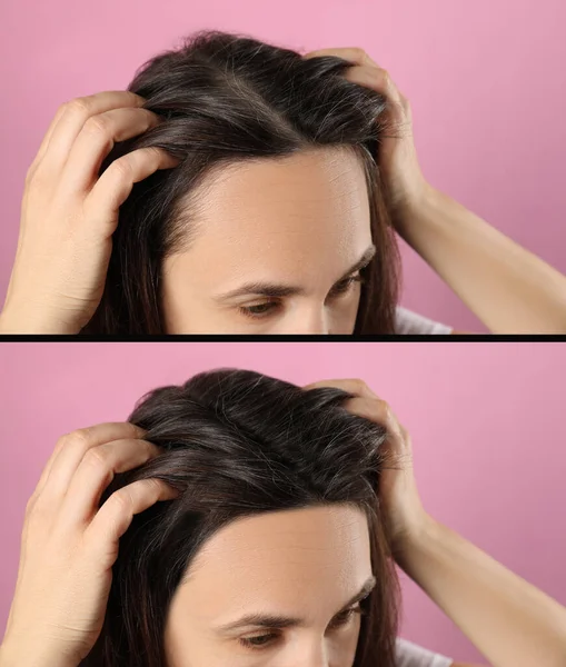 Mujer Que Sufre Calvicie Sobre Fondo Rosa Primer Plano Collage — Foto de Stock