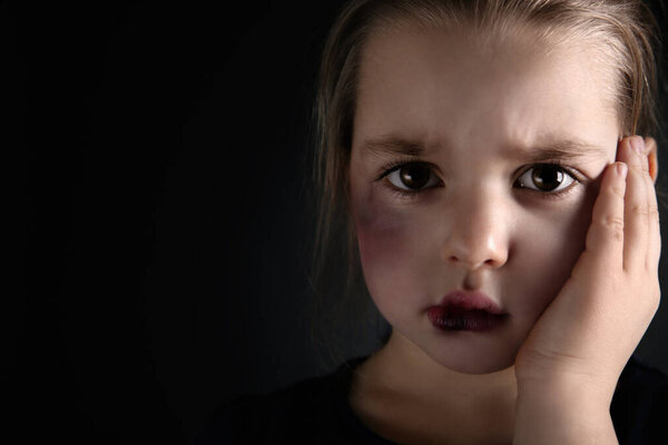 Little girl with bruises on face against dark background, space for text. Domestic violence victim