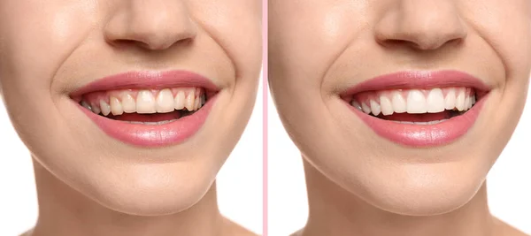 Kolaż Zdjęciami Kobiety Przed Wybielaniu Zębów Zbliżenie Projekt Banera — Zdjęcie stockowe