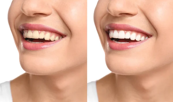 Collage Con Fotos Mujer Antes Después Del Blanqueamiento Dientes Primer — Foto de Stock