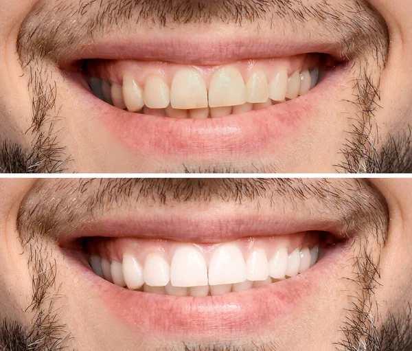 Collage Mit Fotos Von Menschen Vor Und Nach Der Zahnaufhellung — Stockfoto