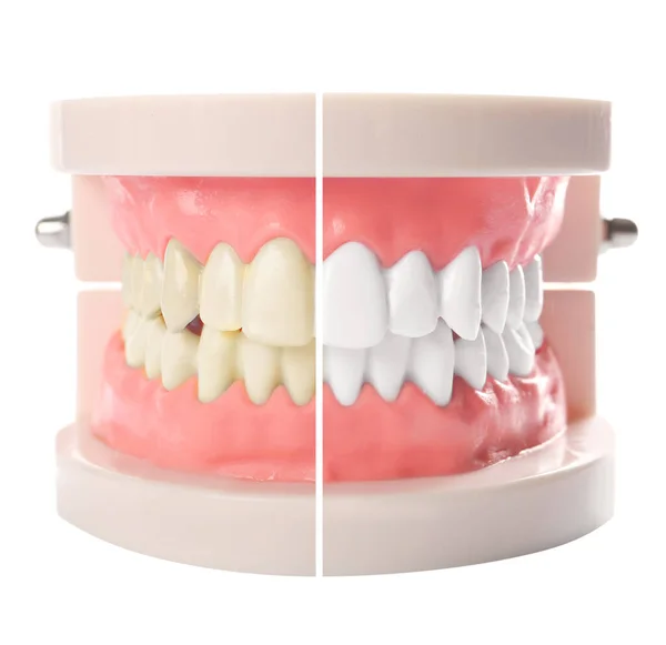 Model Oral Cavity Teeth Whitening White Background — Stock Photo, Image