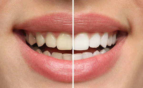 Collage Photos Woman Teeth Whitening Closeup — Stock Photo, Image