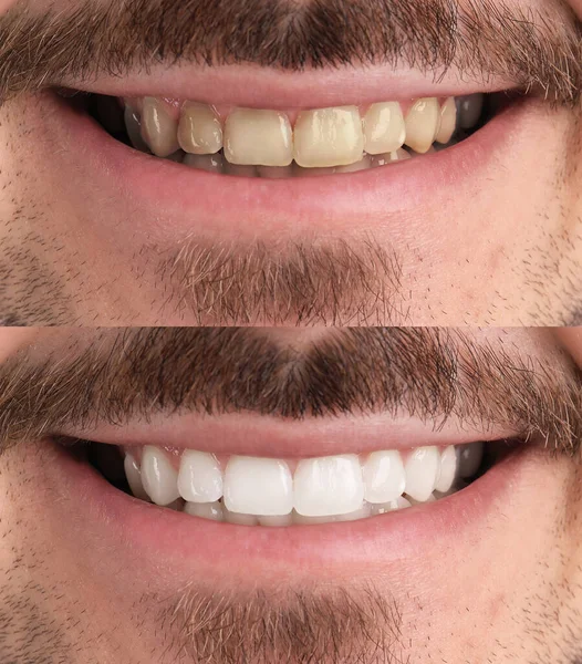 Коллаж Фотографиями Человека После Отбеливания Зубов Крупным Планом — стоковое фото