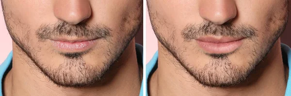 Collage Con Foto Dell Uomo Prima Dopo Aumento Delle Labbra — Foto Stock