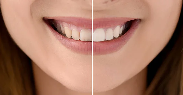 Collage Con Fotos Mujer Antes Después Del Blanqueamiento Dientes Primer — Foto de Stock