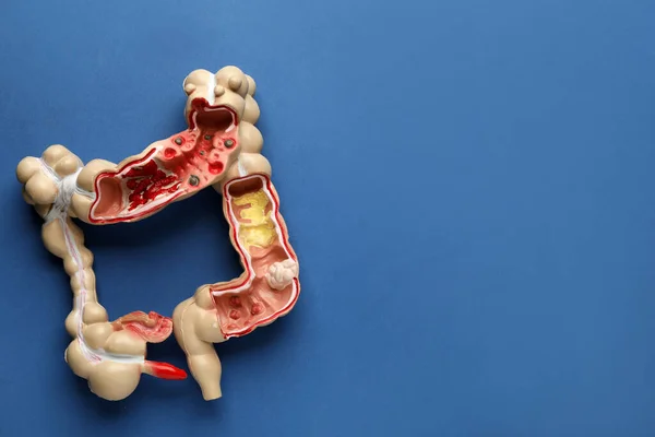 青色の背景に大腸の解剖学的モデル テキストのためのスペースの上のビュー 消化器科 — ストック写真