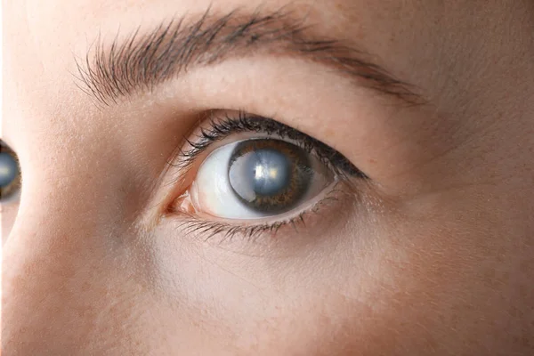 Closeup view of woman suffering from cataract