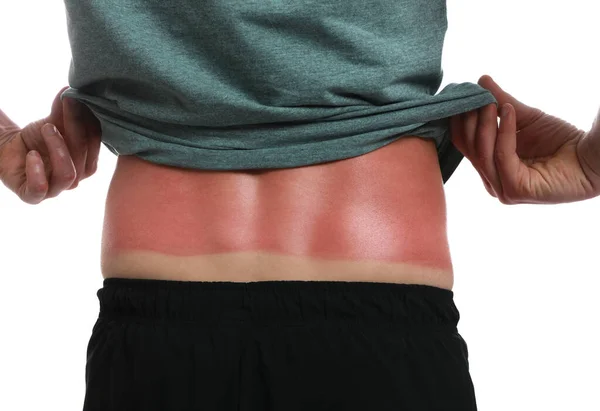 Hombre Con Piel Quemada Por Sol Sobre Fondo Blanco Primer — Foto de Stock