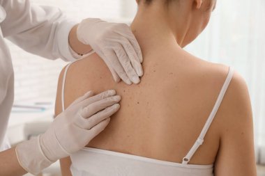 Dermatolog klinikte hastanın doğum lekesini inceliyor.