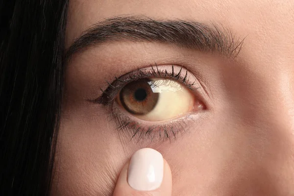 Mulher Verificar Seu Estado Saúde Close Olhos Amarelos Como Sintoma — Fotografia de Stock
