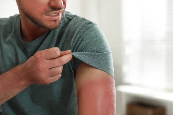 Man Med Solbränd Hud Hemma Närbild — Stockfoto