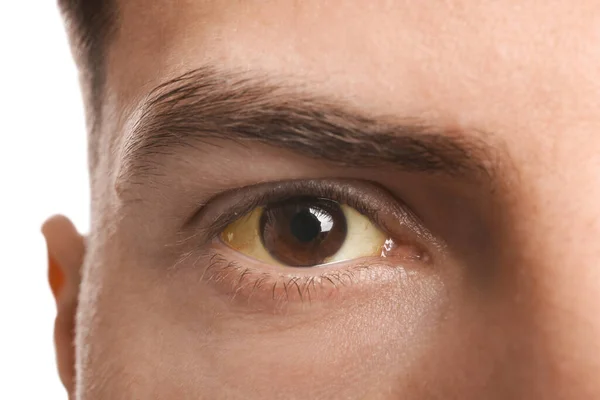 Mann Mit Gelben Augen Auf Weißem Hintergrund Nahaufnahme Symptome Von — Stockfoto