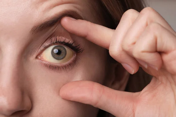 Mujer Revisando Estado Salud Cerca Ojos Amarillos Como Síntoma Problemas —  Fotos de Stock