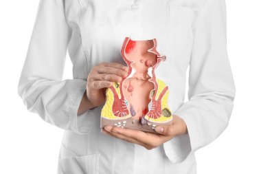 Doctor holding model of unhealthy lower rectum with inflamed vascular structures on white background, closeup. Hemorrhoid problem clipart