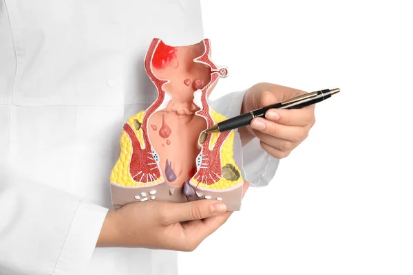 Médico Señalando Modelo Recto Inferior Poco Saludable Con Estructuras Vasculares —  Fotos de Stock