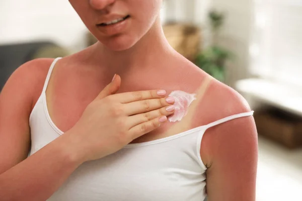 Mujer Aplicando Crema Sobre Quemaduras Solares Casa Primer Plano — Foto de Stock