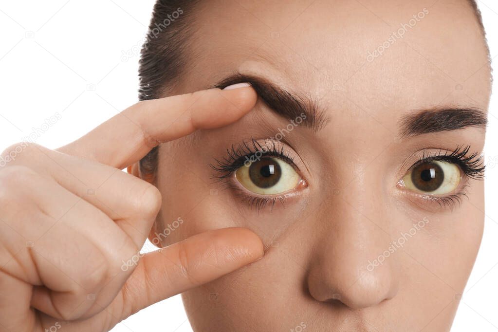 Woman checking her health condition on white background, closeup. Yellow eyes as symptom of problems with liver
