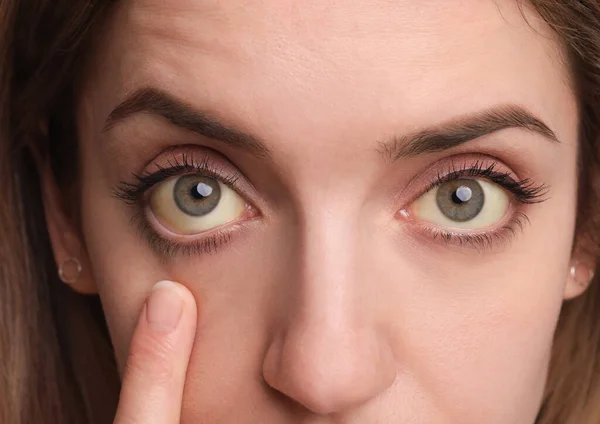 Kobieta Sprawdzająca Stan Zdrowia Białym Tle Zbliżenie Żółte Oczy Jako — Zdjęcie stockowe