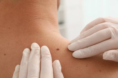 Dermatolog klinikte hastanın doğum lekesini inceliyor.