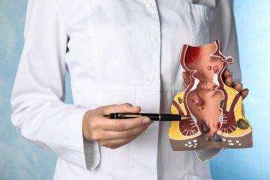 Doktor açık mavi arka planda sağlıksız alt rektum modeline işaret ediyor. Yakın plan. Hemoroit problemi
