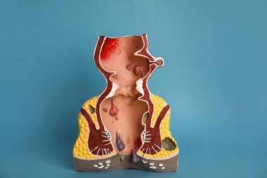 Açık mavi arkaplanda basur bulunan rektumun anatomik modeli