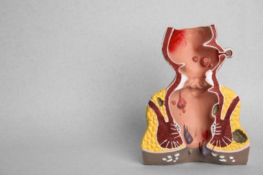 Hafif arka planda basur bulunan rektumun anatomik modeli. Metin için boşluk
