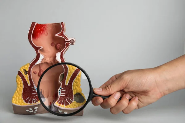 Proctolog Hålla Förstoringsglas Nära Anatomisk Modell Rektum Med Hemorrojder Ljus — Stockfoto