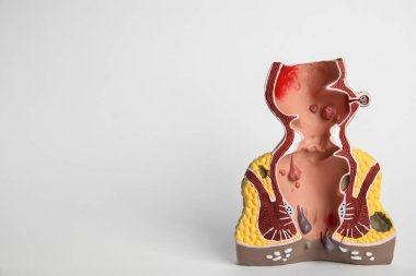 Hafif arka planda basur bulunan rektumun anatomik modeli. Metin için boşluk