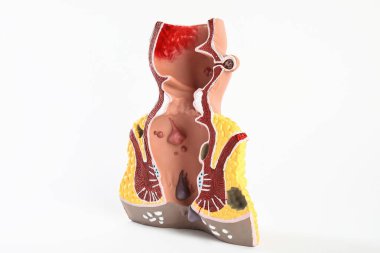 Beyaza izole edilmiş basurlu rektumun anatomik modeli