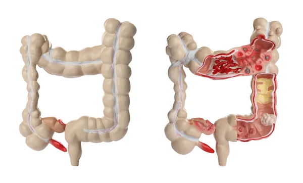 Beyaz Arka Planda Kalın Bağırsağın Anatomik Modeli Kolaj Gastroenteroloji — Stok fotoğraf