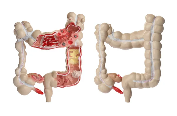 白い背景に大腸の解剖学的モデル コラージュ 消化器科 — ストック写真
