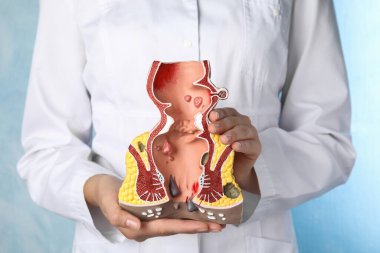 Doktor açık mavi arka planda sağlıksız rektum modelini tutuyor, yakın plan. Hemoroit problemi