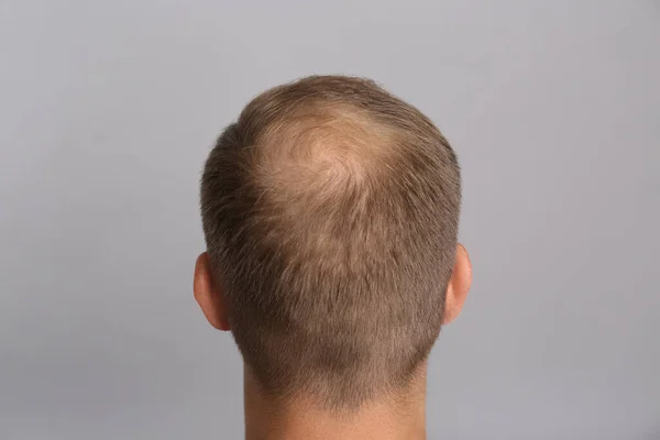 灰色の背景に脱毛の問題を持つ男 バックビュー トライコロジー治療 — ストック写真