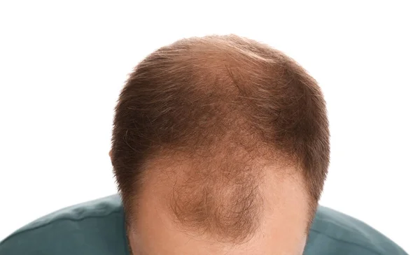 Muž Problémem Vypadávání Vlasů Bílém Pozadí Detailní Záběr Trichologická Léčba — Stock fotografie