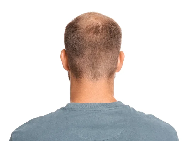 Man Hair Loss Problem White Background Back View Trichology Treatment Stock Photo